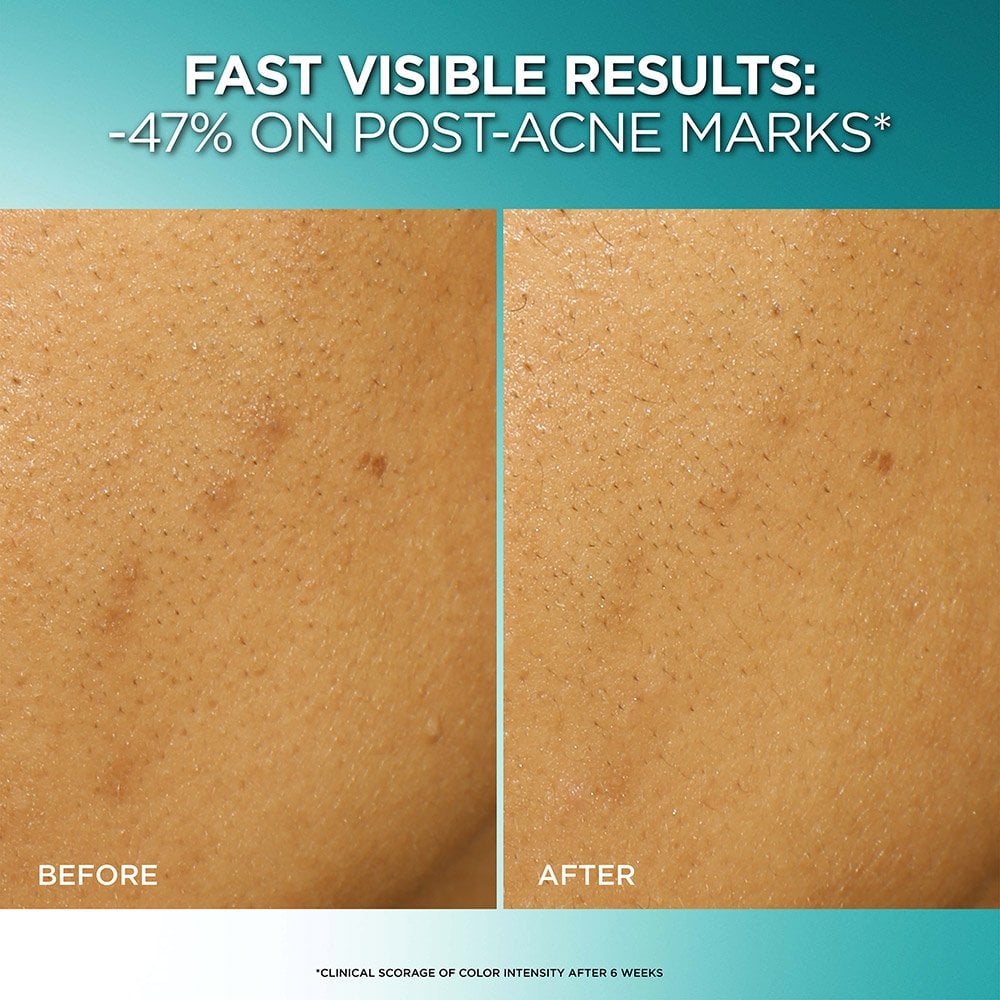 L’Oreal Bright Reveal Peeling Exfoliante para Manchas Oscuras